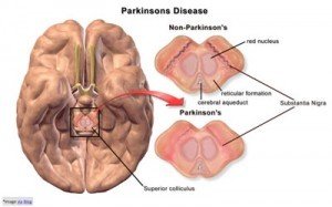 Parkinson-doença-300x187