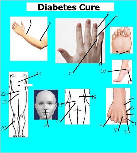 Diabetes Cure with acupressure