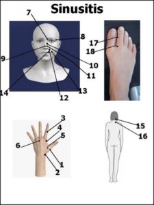 Sinusitis