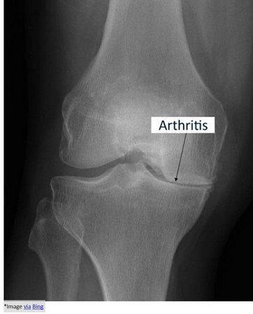 arthritis