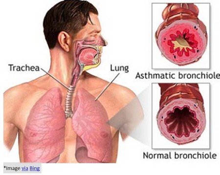 asthma and bronchitis