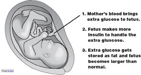 Gestational Diabetes