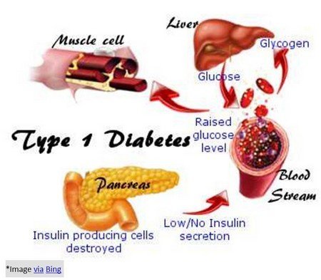 Type I or Juvenile Diabetes