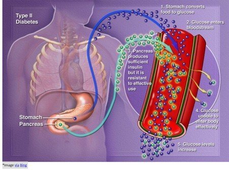 Type II Diabetes