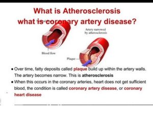 cholesterol