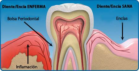 gum diseases