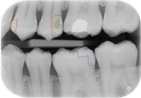 tooth decay