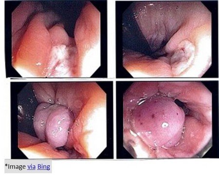 Banding for prolapsed haemorrhoids