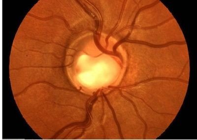 Glaucoma-400x285