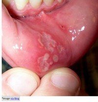 Mouth-ulcer