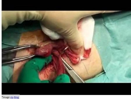 haemorrhoidectomy