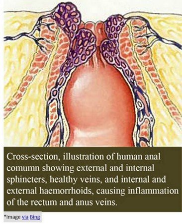 haemorrhoids