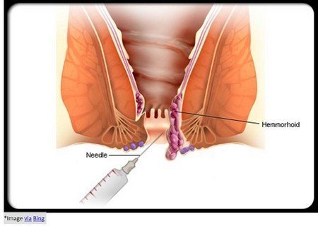 sclerotherapy for internal haemorrhoids