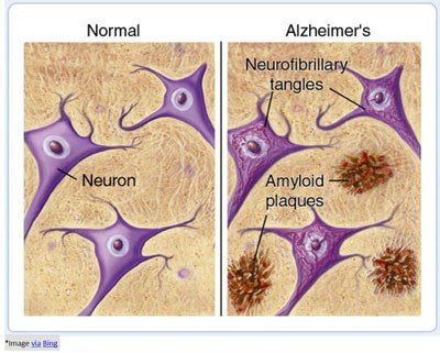 enfermedad de alzheimer