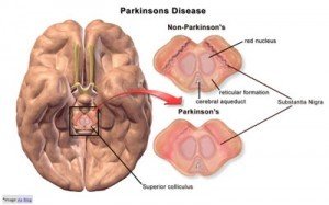 Parkinson-enfermedad-300x187