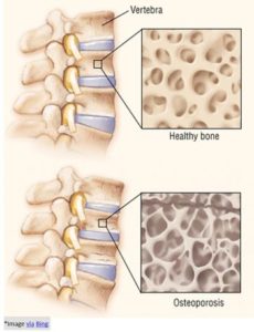 osteoporosis