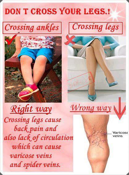 Varicose Veins Causes, Prevention