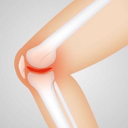 Osteoarthritis