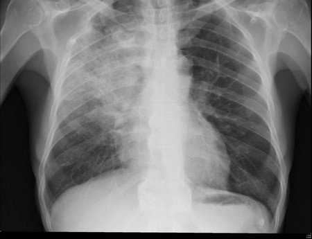 Children's Pneumonia