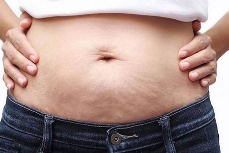 Obesity Causes Skin Problems