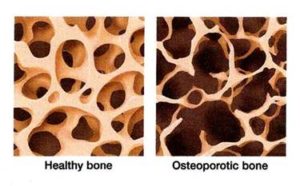 Osteopenia Risk Factors, Symptoms, Signs, Causes And Treatment