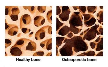 Osteopenia’s Risk factors, symptoms, signs, causes and Treatment