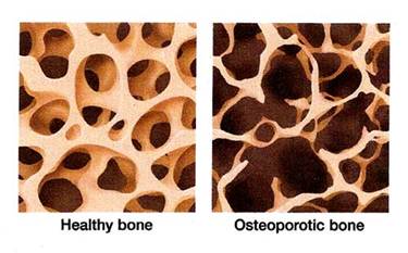 Osteopenia