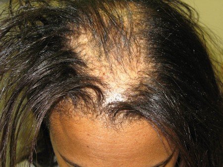 Diabetes Can Lead To Hair Loss Due To Hormone Disorder