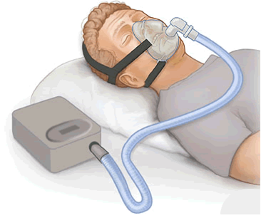 sleep apnea