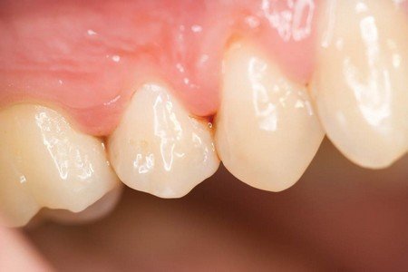 Gingivitis Causes, Treating and Preventing