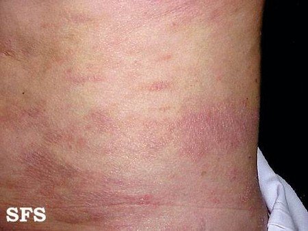Cure Psoriasis with Natural Treatment/ Remedies