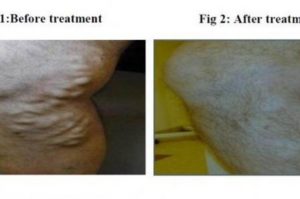 Varicose-Veins-condition