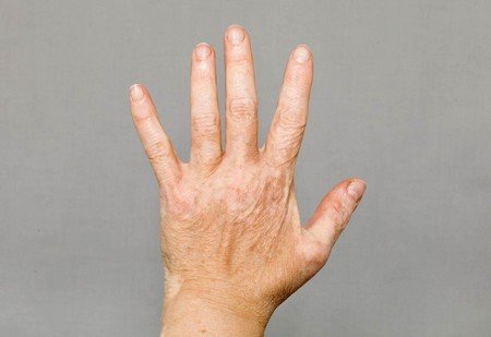 Vitiligo Causes, and Vitiligo Treatment Options