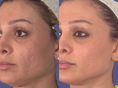 treat hyperpigmentation and age-spots