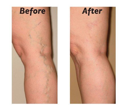 Varicose Veins Treatment Options