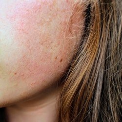 cure eczema skin