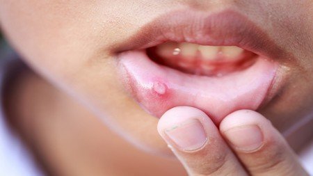 Types of Herpes, Symptoms and Cure