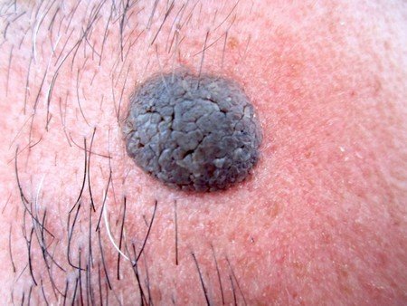 What are Moles and How to Remove Them