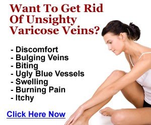 varicose veins 300X250