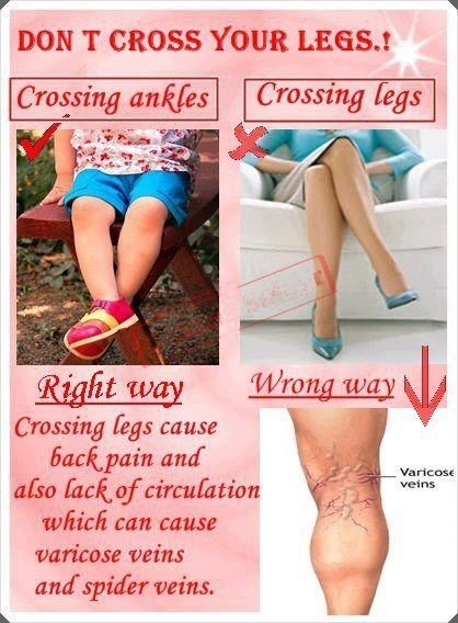 varicose veins