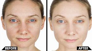 Dehydrated Skin before and after