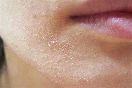 Dry skin