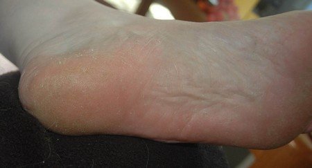 Foot skin