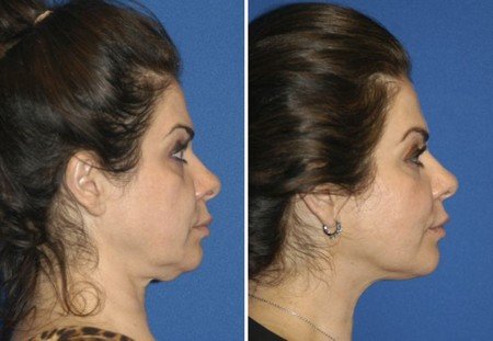 Get Rid of Double Chin Without Surgery