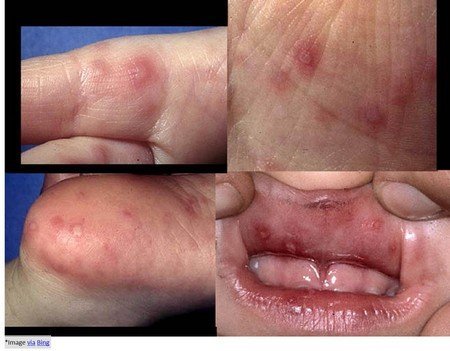 Hand-foot-and-mouth-disease-blister