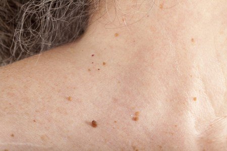 Home Remedies to Remove Skin Tags