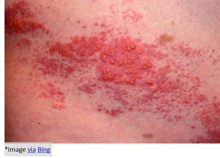 Shingles-and-Chicken-pox-Blisters