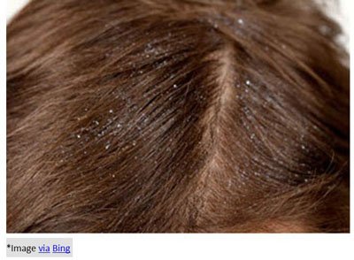 Home Remedies to Get Rid of Dandruff
