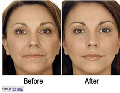 non-surgical-face-lift