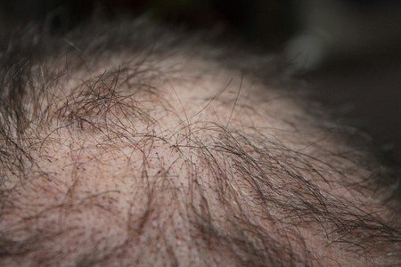Home Remedies to Get Rid of Hair Fall Problem